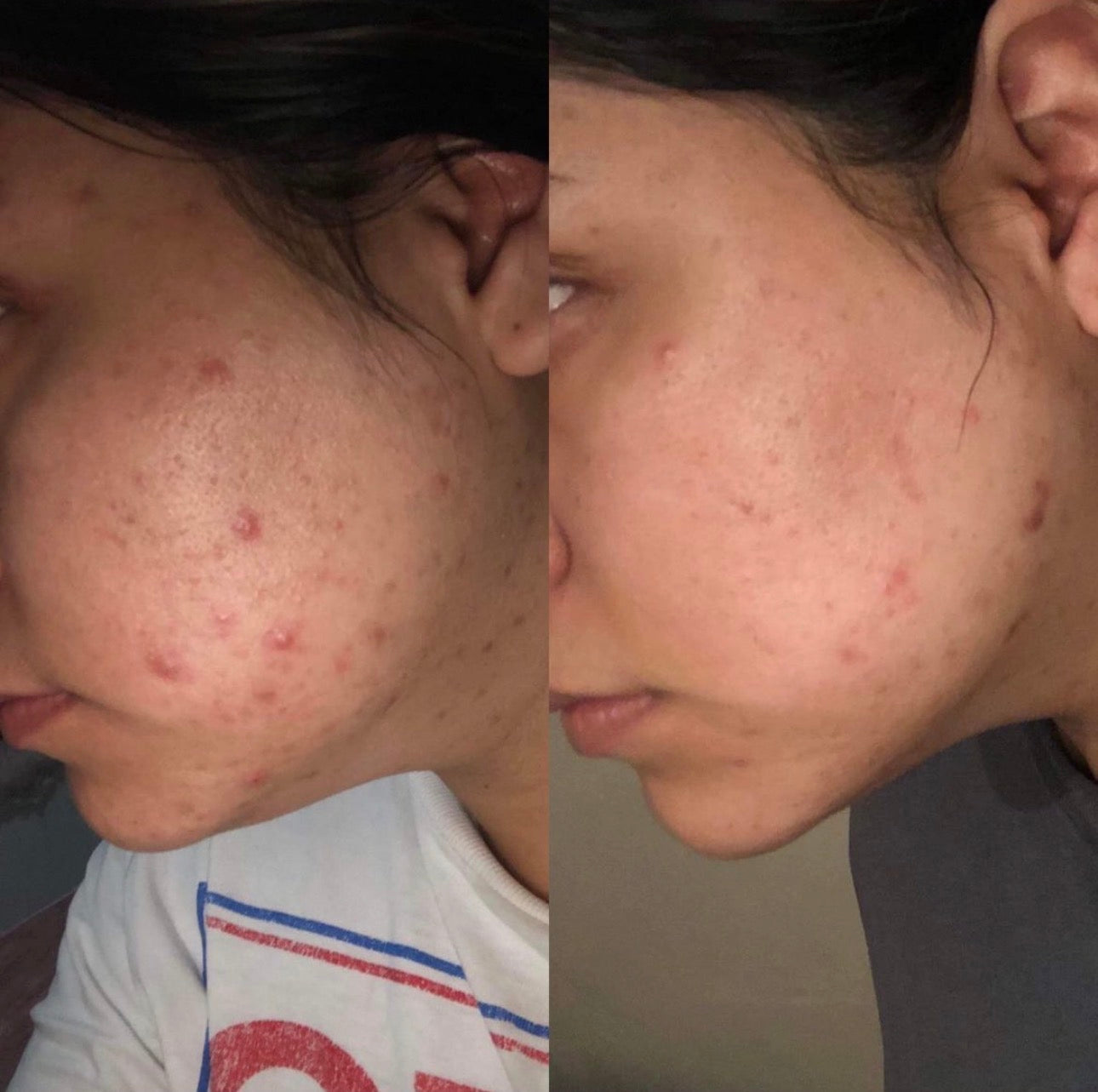 Comparación de piel después de dos meses de uso constante